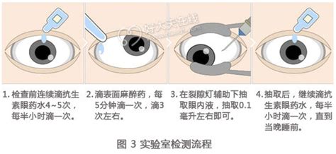 眼睛有波紋|你遇到過“眼前水波紋感”嗎？